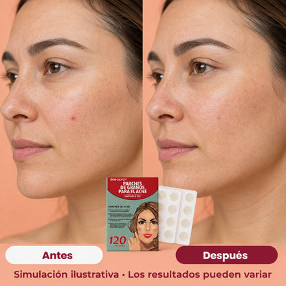 3 packs de parches para acné (120 unidades)