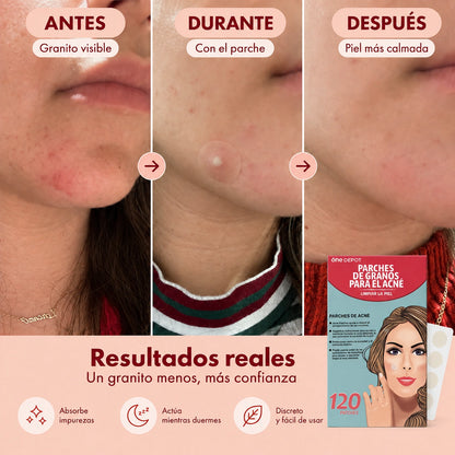 3 packs de parches para acné (120 unidades)
